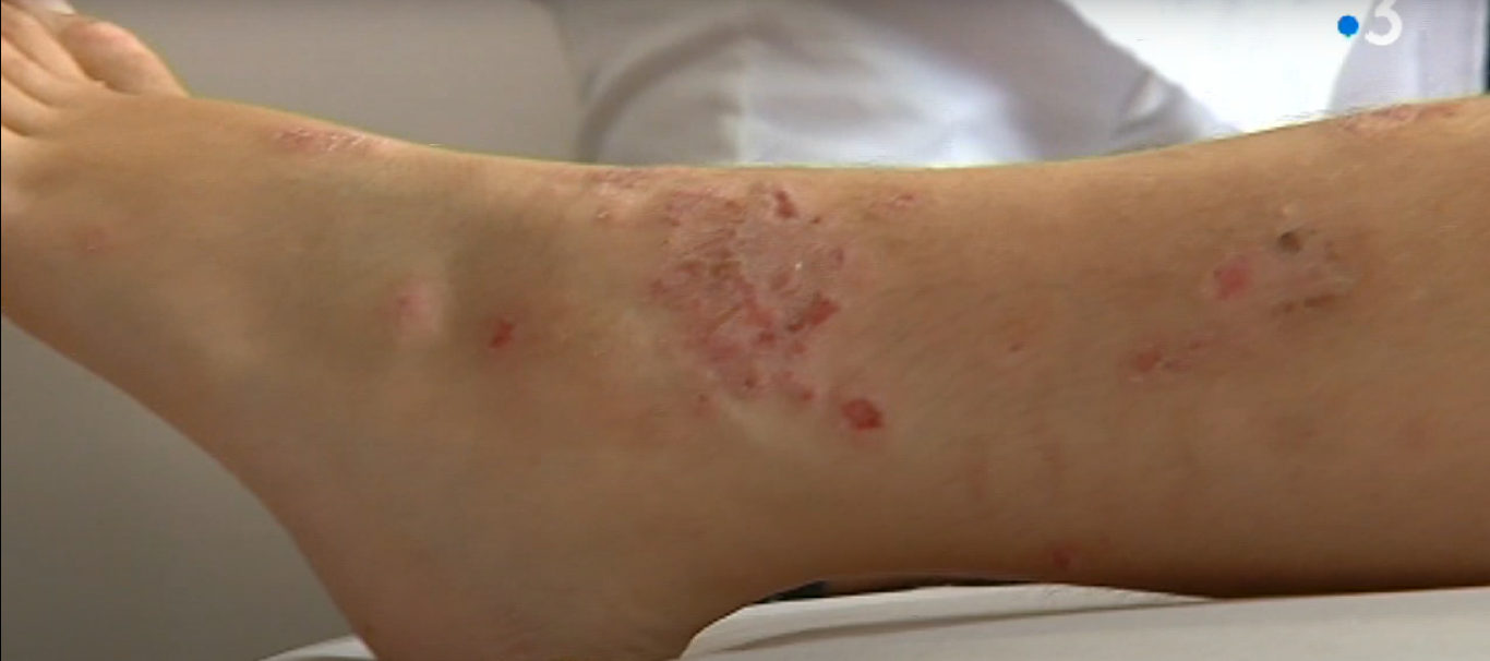 diabète tache sur les jambes photos: 7 Causes Fréquentes